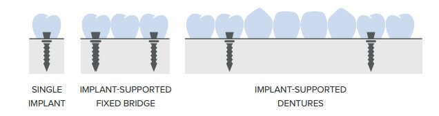 Diagram of Different Types of Dental Implants