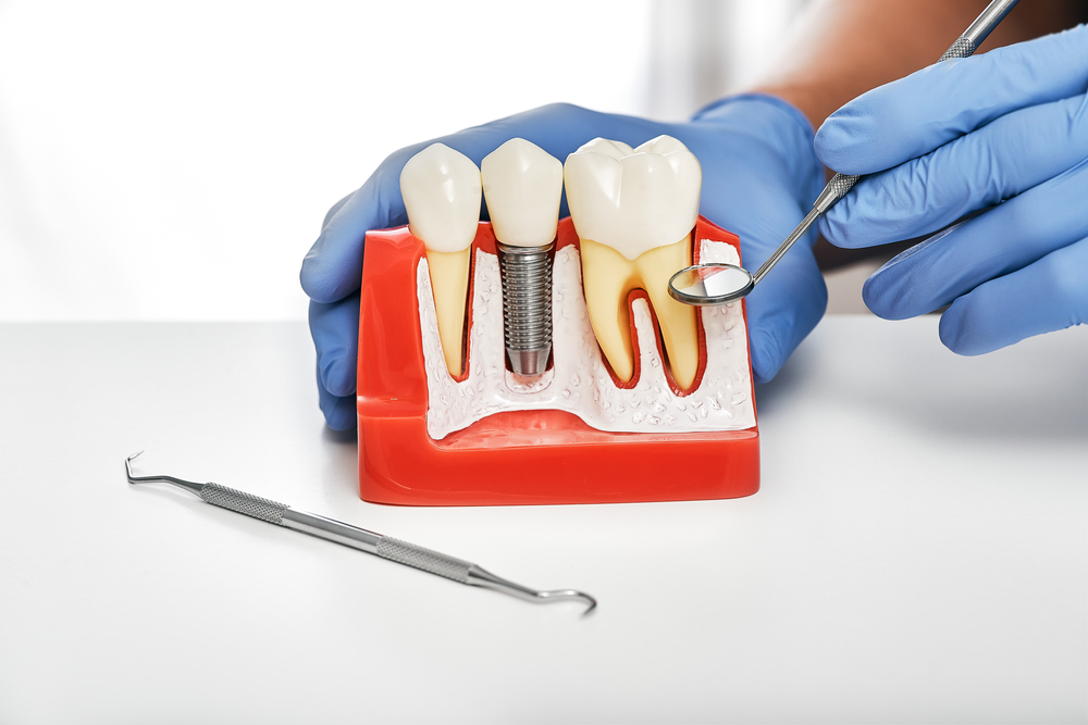 Types of Dental Implants