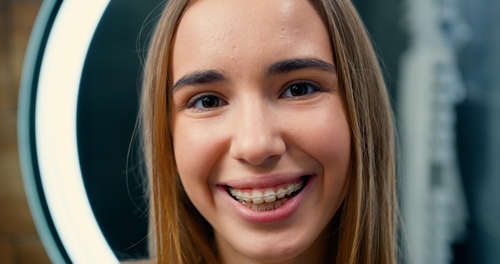 Ceramic Braces