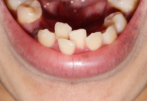 Overlap Teeth Crowding